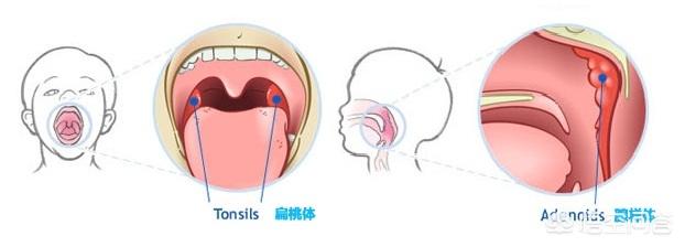 小孩打鼾是什么原因引起的，孩子睡觉经常打呼噜怎么办