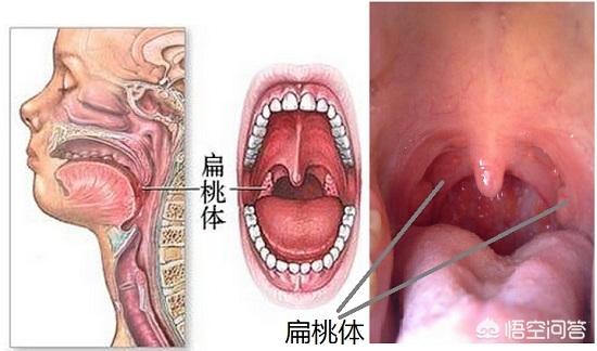 头条问答 每个人都会长扁桃体结石吗 Kin吉兰的回答 0赞