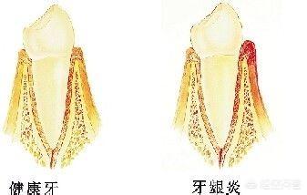 牙龈出血怎么办,牙龈出血怎么办 立刻止血