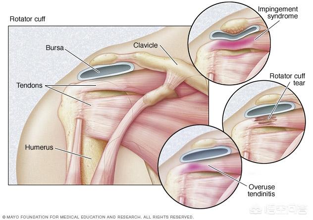 肩袖损伤为何发病率非常广泛，肩袖损伤是肩膀痛主要原因吗