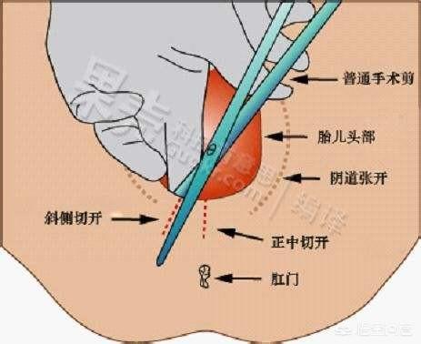 生產時自然撕裂還是側切恢復的快有什麼區別及影響