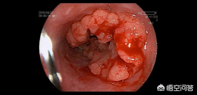 食管癌早期症状:食道癌的早期症状难觉查吗