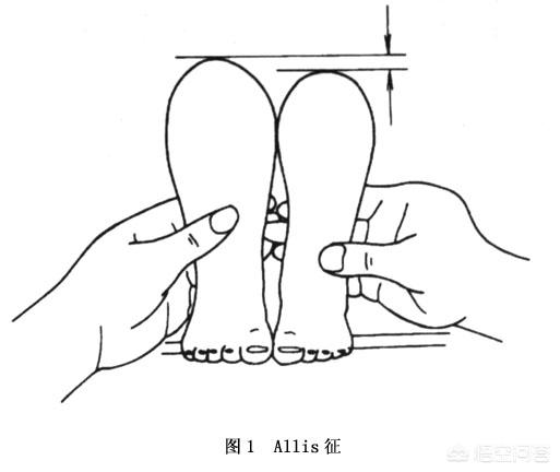 小儿髋关节脱位:小儿髋关节脱位的表现症状 如何判断宝宝是否髋关节发育不良？