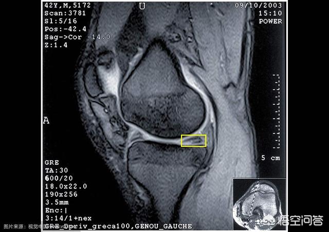 头条问答 半月板2度损伤 如何理疗 25个回答