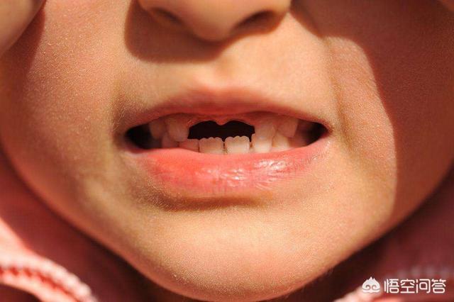 头条问答 - 四至五岁的小孩牙齿掉是怎么回事?(1个回答)