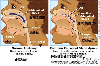 小孩打鼾是什么原因引起的，孩子睡觉经常打呼噜怎么办