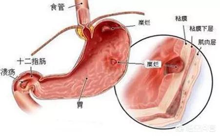 胃癌晚期症状：胃癌晚期症状能活多久