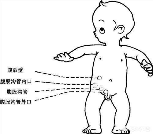 隐睾症:隐睾症能生育吗 刚出生的婴幼儿有隐睾是怎么回事？