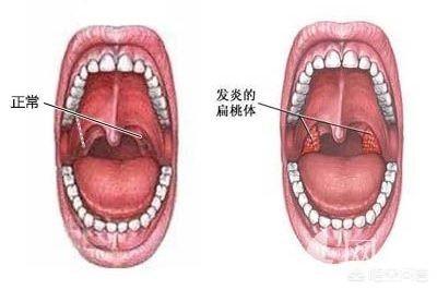 头条问答 喉咙好像有一个东西咽不下去也吐不出来是什么 怎么回事 4个回答