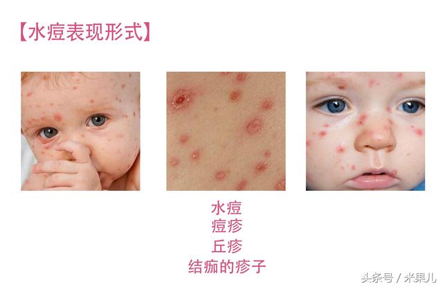 婴儿湿疹要怎么才能治好？