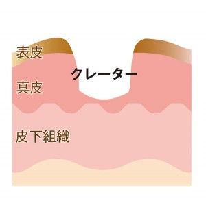 怎么去痘印啊(怎么快速去痘印啊)