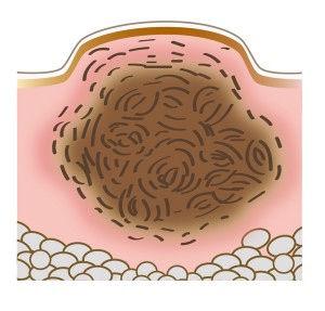怎么去痘印啊(怎么快速去痘印啊)