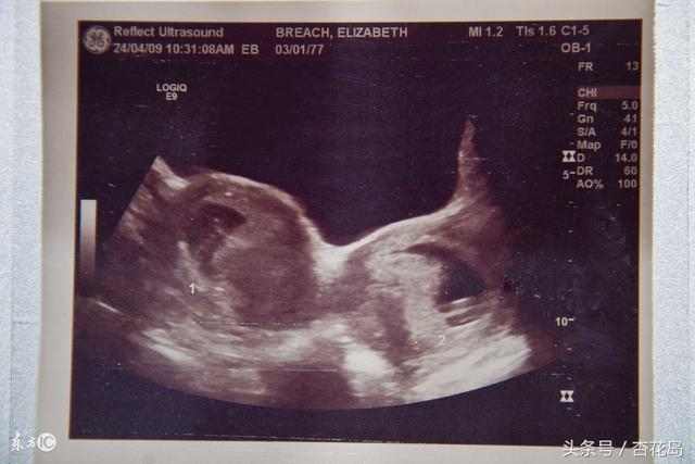 双子宫是怎么回事(双子宫是怎么回事影响生育吗)