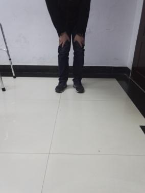 前交叉韧带断裂术后锻炼:前交叉韧带断裂，需要立刻手术吗？