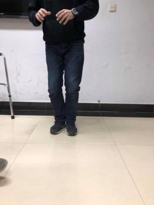 前交叉韧带断裂术后锻炼:前交叉韧带断裂，需要立刻手术吗？