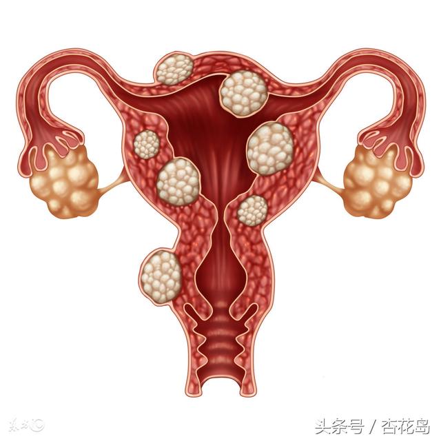 子宫肌瘤能喝黑枸杞吗，子宫肌瘤可以喝豆浆、吃桂圆红枣吗？