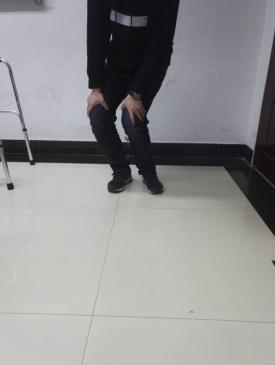 前交叉韧带断裂术后锻炼:前交叉韧带断裂，需要立刻手术吗？