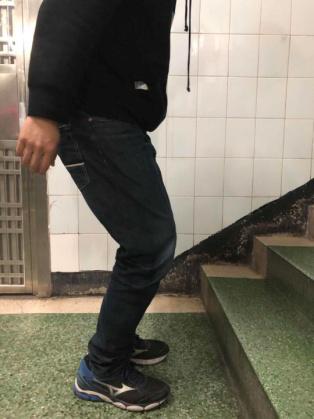 前交叉韧带断裂术后锻炼:前交叉韧带断裂，需要立刻手术吗？