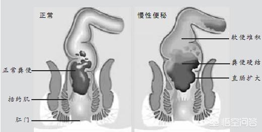 便秘脱肛的治疗昆明:两岁宝宝便秘有些严重，怎么办？