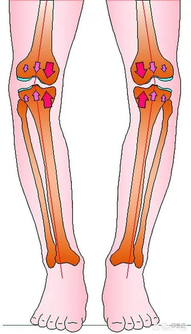 罗圈腿矫正(罗圈腿矫正手术大概需要多少钱)