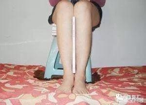 罗圈腿矫正(罗圈腿矫正手术大概需要多少钱)