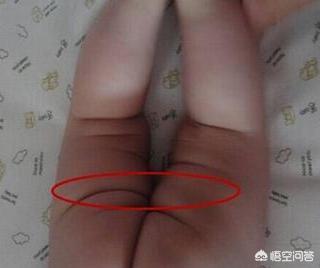 小儿髋关节脱位:小儿髋关节脱位的表现症状 如何判断宝宝是否髋关节发育不良？