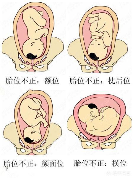 头位左枕横位胎儿图图片
