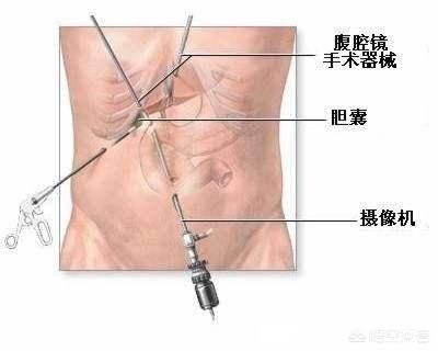 头条问答 胆结石是如何形成的 除了摘除之外 就没有好的办法了吗 骨伤的杨张张扬的回答 0赞