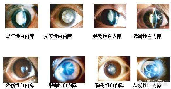 白内障怎么形成的