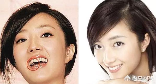 姚笛整容前:哪个明星整牙前最丑整牙等于整容么