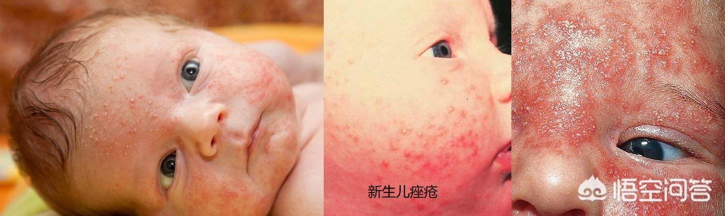 宝宝快三个月了，脸上起了湿疹还有一些发红，有什么办法治疗？