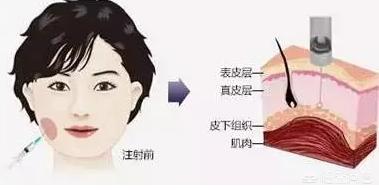 刘涛打瘦脸针面部凹陷，如何防止打完瘦脸针面部僵硬、凹陷