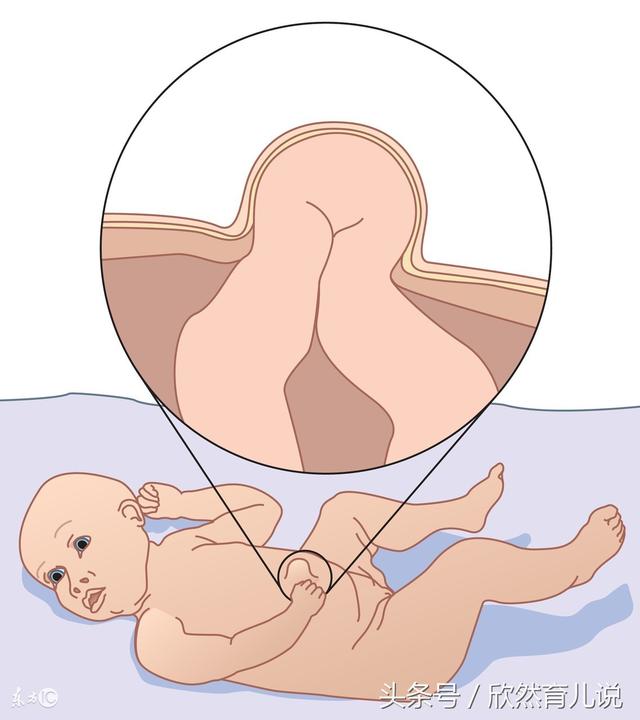 婴儿脐疝:新生儿脐疝像小鸡蛋那么大了，有什么好的处理办法？