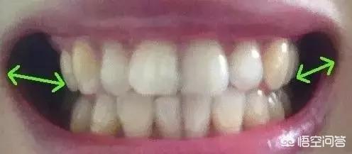 姚笛整容前:哪个明星整牙前最丑整牙等于整容么