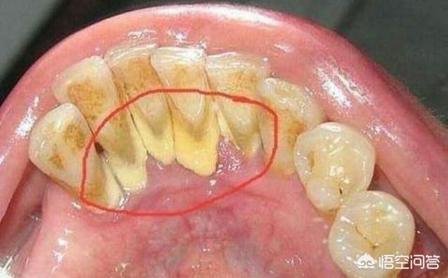 牙齿总能抠出"黄泥",非常臭,这到底是什么东西?怎么去除不再有?