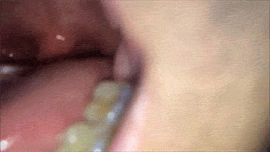 头条问答 扁桃体结石怎么排出 能不能自愈 的回答 0赞