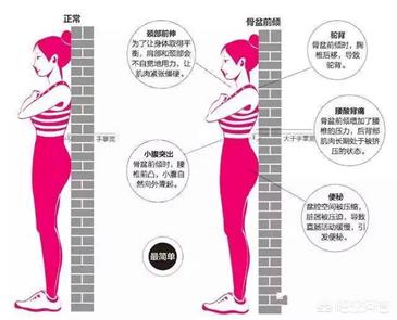 如何判断和矫正骨盆前倾？