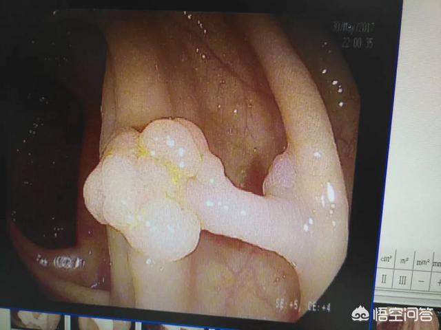 肠癌转移肝癌化疗10几次，为什么没有消瘦身体各项指标都正常？ 肠癌转肝癌化疗多少次