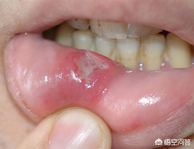 口腔溃疡症状:患有口腔溃疡通常都有什么症状？应该怎么缓解？