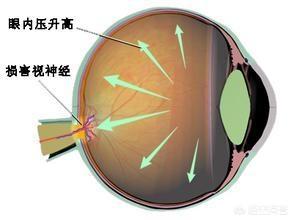 青光眼是怎么得的呢？
