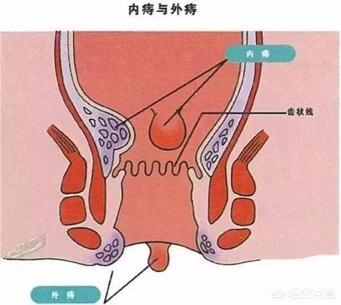 小孩血便是什么原因引起的:血便是什么原因引起的女性 5岁儿童肛门大便时流血是怎么回事？