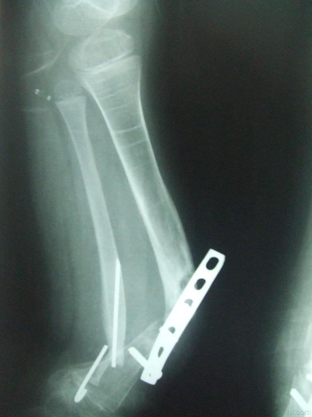 头条问答 胫腓骨骨折多少天可以脱拐 5个回答