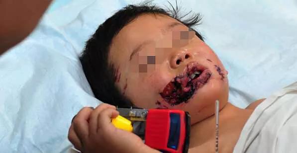 固镇狗咬死小孩:孩子被狗追，怎么教他自救？