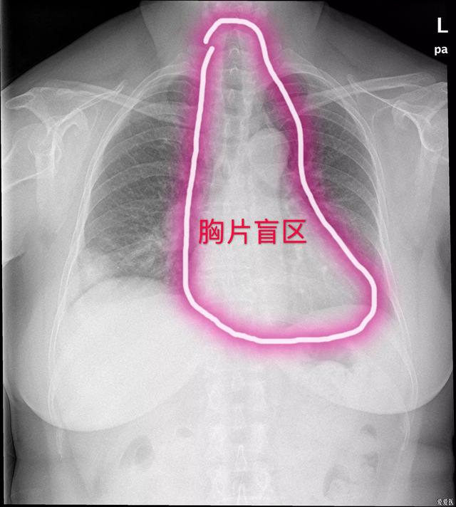 诊断早期心肺病的主要依据:胸片、胸透能早期筛查肺癌吗？