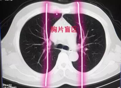 鳞癌早期图片:肺鳞癌活了15年，可以活的时间久一些吗要注意什么