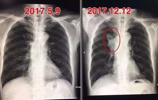 鳞癌早期图片:肺鳞癌活了15年，可以活的时间久一些吗要注意什么