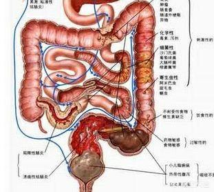 慢性结肠炎的症状是肚脐眼疼吗