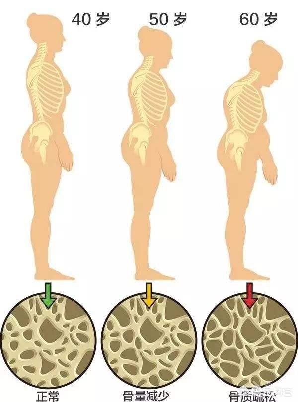 为何天天喝奶还是患上骨质疏松，骨质疏松症为何被称为隐形杀手常喝碳酸饮料会导致骨质疏松吗