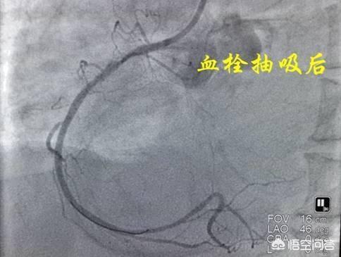 风靡<a href=https://maguai.com/list/256-0-0.html target=_blank class=infotextkey>朋友圈</a>的血管栓塞消融新<a href=https://maguai.com/list/30-0-0.html target=_blank class=infotextkey>科技</a>:人体的血栓能不能抽出来过滤掉？