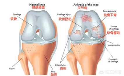 膝盖软骨磨损和风湿什么区别:风湿关节炎引起的软骨磨损 阴雨天膝关节疼痛是什么原因呢？
